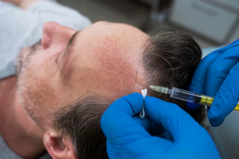 man getting hair loss treatment 23 2149152756